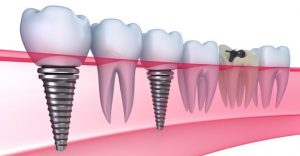 so sánh làm cầu răng và trồng răng implant 1