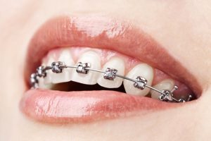 Những câu hỏi cần biết về niềng răng