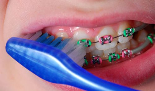 Niềng răng có hại không? 1