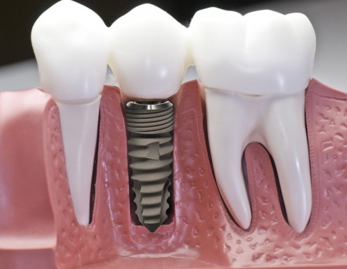 Chi phí cấy ghép răng implant nha khoa hiện nay 1