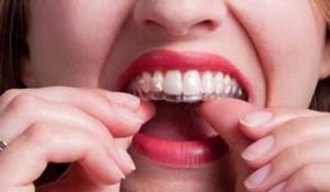 Niềng răng Invisalign giúp bạn đẹp mọi lúc 1