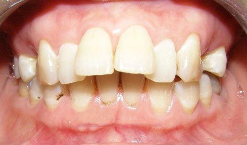 Những đặc điểm của răng hô 1