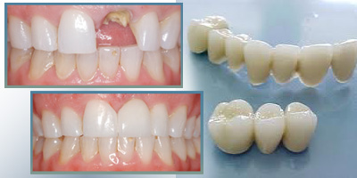 Những loại răng sứ thẩm mỹ 1