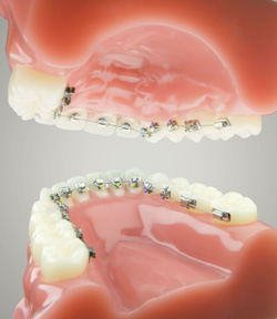 Những phương pháp niềng răng thẩm mỹ 2