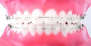 Những phương pháp niềng răng thẩm mỹ 1