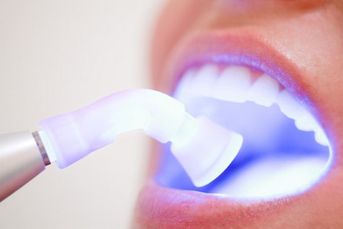 Tẩy trắng răng có hại hay không?2