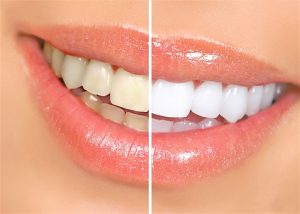 Tẩy trắng răng có hại hay không ?