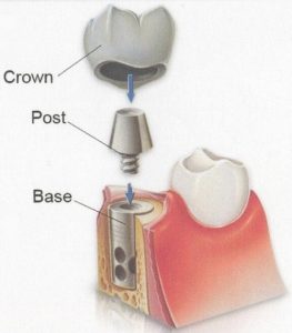 Trồng răng implant là gì? 1