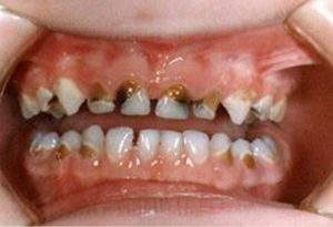 Những trường hợp nên bọc răng sứ 2