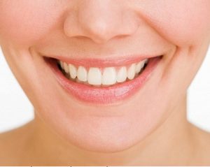 Niềng răng tốt hay hại đến sức khỏe? 2