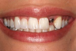 Trồng răng giả kịp thời để bảo vệ hàm răng 2