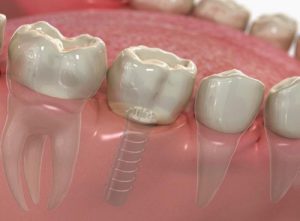 Trồng răng giả kịp thời để bảo vệ hàm răng 1