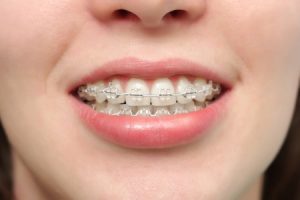 Ứng phó với hàm răng lệch lạc như thế nào? 2