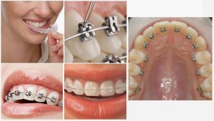 Cần phải làm gì khi răng bị hô móm? 1