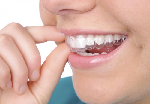 Phương pháp niềng răng thẩm mỹ tốt nhất 2