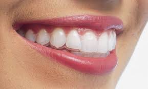 Phương pháp niềng răng thẩm mỹ tốt nhất 1