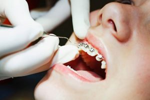 Các loại niềng răng mắc cài phổ biến hiện nay 1