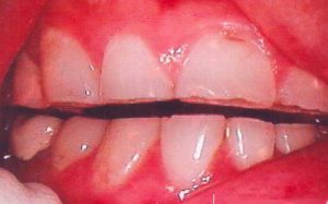 Cách khắc phục khi răng bị mòn mặt nhai 1