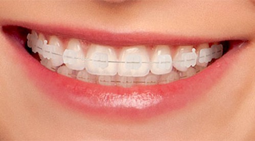 Cải thiện hàm răng dưới mọc chen chúc 1