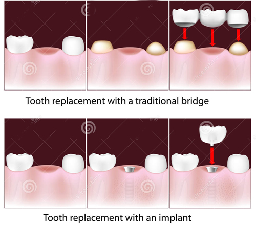 Điểm khác biệt trồng răng implant so với cầu răng sứ 2