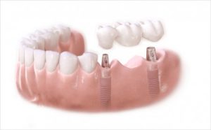 Kết hợp cấy ghép implant và làm cầu răng sứ 2