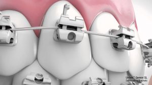 Các loại niềng răng mắc cài phổ biến hiện nay 2