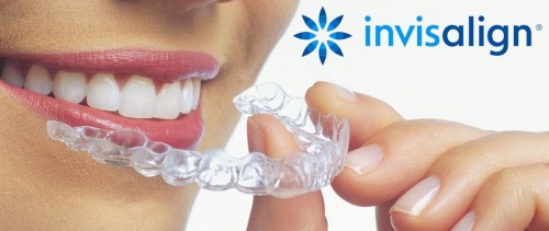 Niềng răng bằng nhựa có chi phí cao không? 2