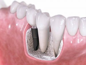 Phục hình răng hàm bị mất bằng cách trồng implant