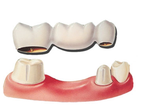 Trồng răng giả khi mất răng để hàm răng chắc khỏe 2