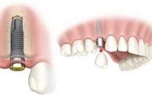 Trồng răng giả khi mất răng để hàm răng chắc khỏe