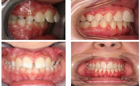 Điều trị răng hô 2