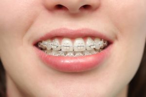 Các loại niềng răng mắc cài phổ biến hiện nay 3