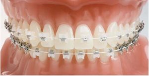 Vệ sinh răng miệng khi điều trị rối loạn khớp cắn 1