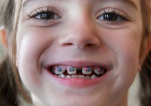 Quy trình niềng răng trẻ em 1