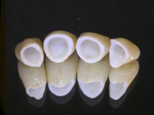 Phục hình răng bị mất với răng sứ
