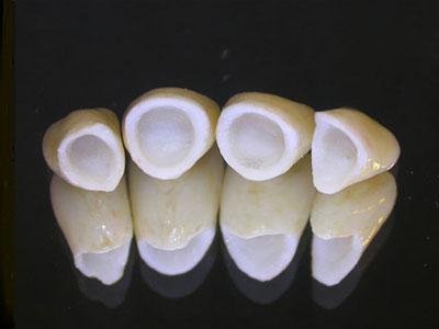 Phục hình răng bị mất với răng sứ 1