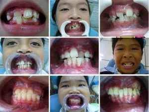 Quy trình niềng răng trẻ em 2
