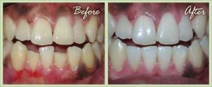 Hiệu quả của việc bọc răng sứ khi răng sứt mẻ-2