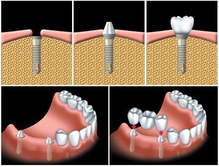 Trồng răng implant ở đâu tốt nhất? 2