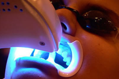 Phương pháp tẩy trắng răng rút ngắn trong khoảng 1 giờ 1