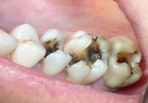 Tình trạng răng sâu bị sứt mẻ và cách khắc phục 
