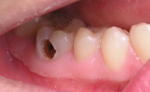 Hiệu quả của trám răng điều trị sâu răng 2