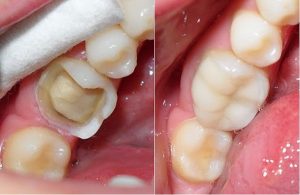 Hiệu quả của trám răng điều trị sâu răng 1