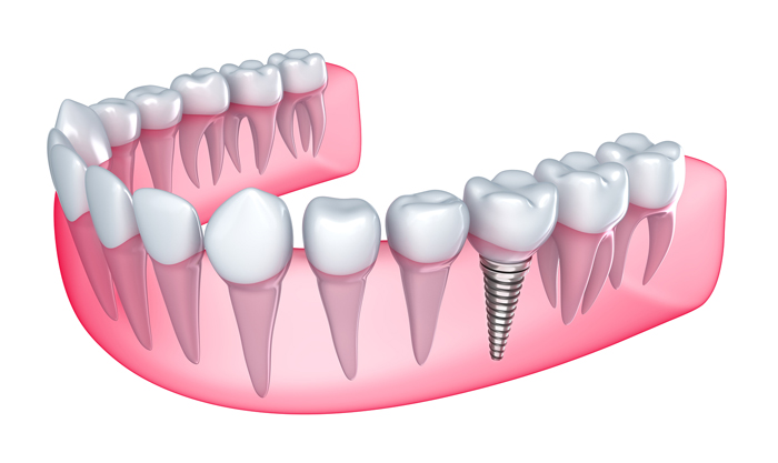 Implant phương pháp phục hồi răng giả mới nhất 2
