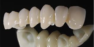 Những loại răng sứ hiện nay 1