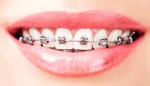 Thẩm mỹ hàm răng với niềng răng 1