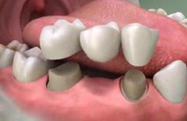 Những giải pháp làm răng giả chất liệu sứ 2