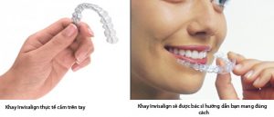 Cách chọn khí cụ chỉnh nha đạt tính thẩm mỹ cao 2