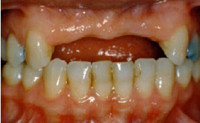 Xua tan nỗi lo mất răng với trồng răng implant 1