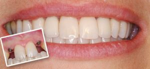Xua tan nỗi lo mất răng với trồng răng implant 3